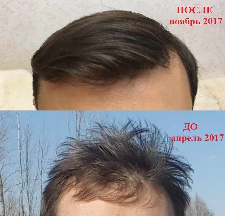 Сколько отрастают волосы у мужчин. Маска от облысения для мужчин. Перцовка для волос до после лысины. Маска для волос от лысины. Волосы до и после рост волос.