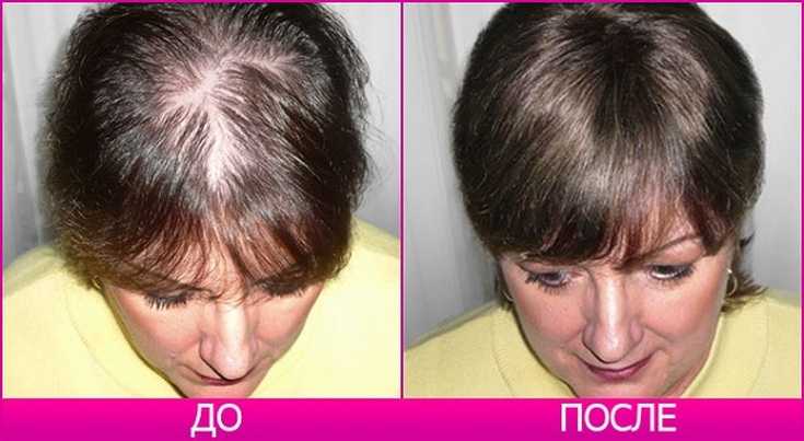 Волосы выпадают после лечения. Женское облысение до после.