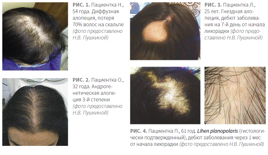 Выпадение волос алопеция у женщин.