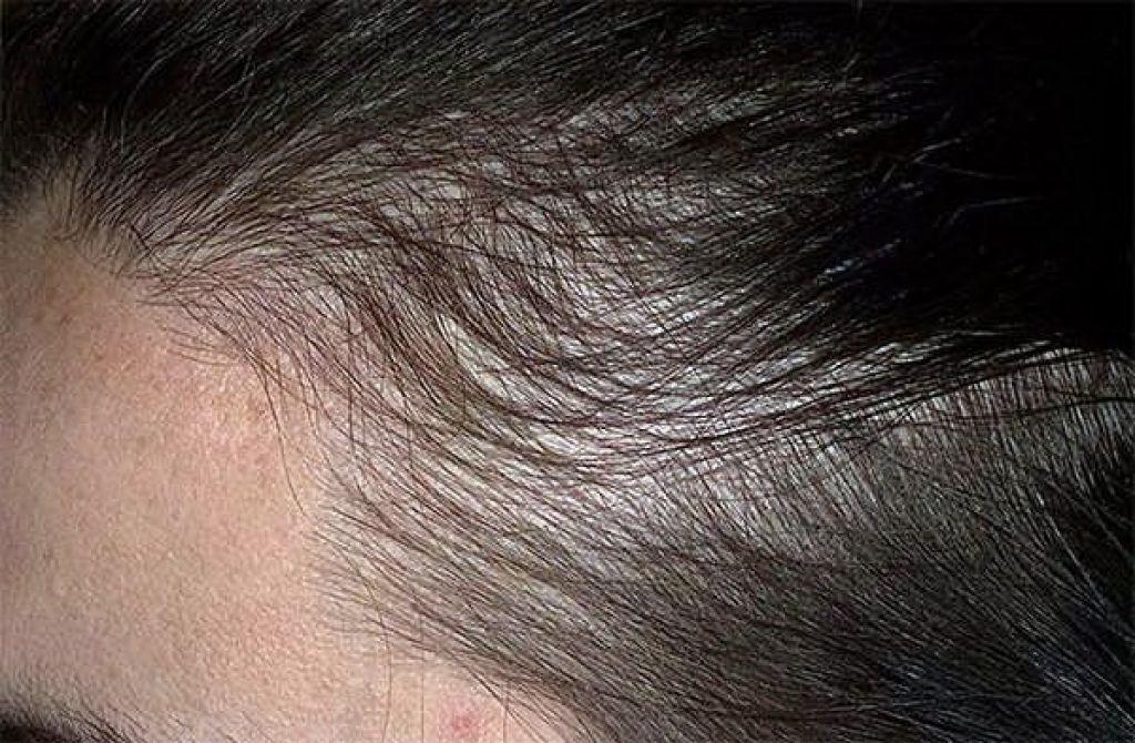 Фото выпавших волос. Диффузная телогеновая алопеция. Андрогензависимая алопеция. Телогеновая гнездная алопеция.
