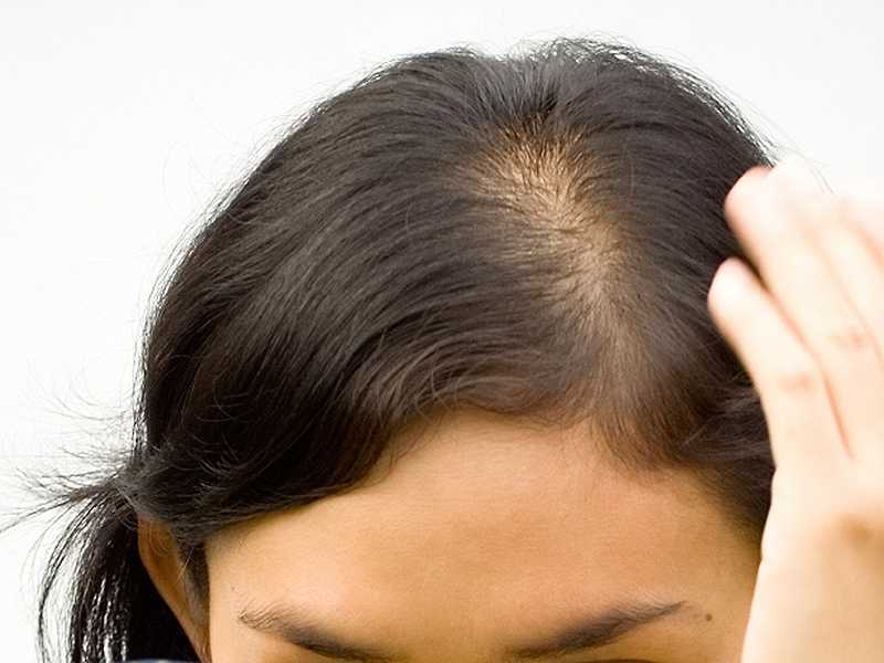 Что делать при выпадении волос врач