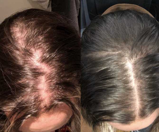 Может ли краска для волос помогать от выпадения