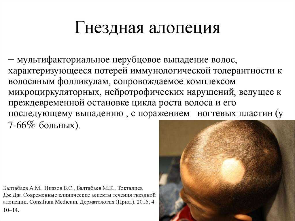 Выпадение волос головы причина лечение. Очаговая гнездная алопеция у детей.
