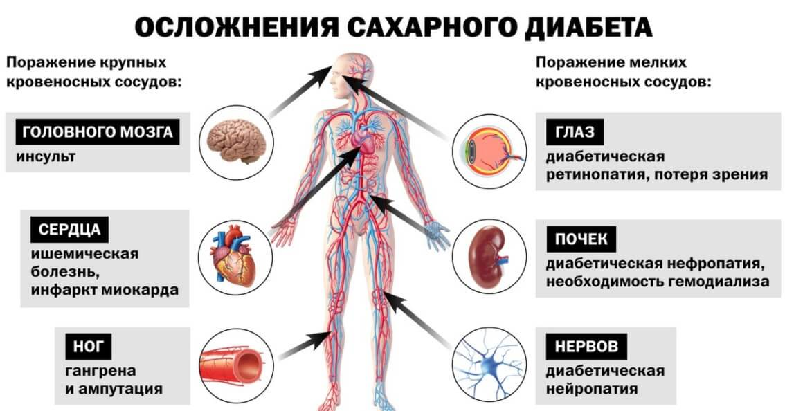 Причины частой болезни. Хронические осложнения СД. Осложнения СД 1 типа и 2 типа. Осложнения СД 2 типа. Диабетические осложнения 1 типа.