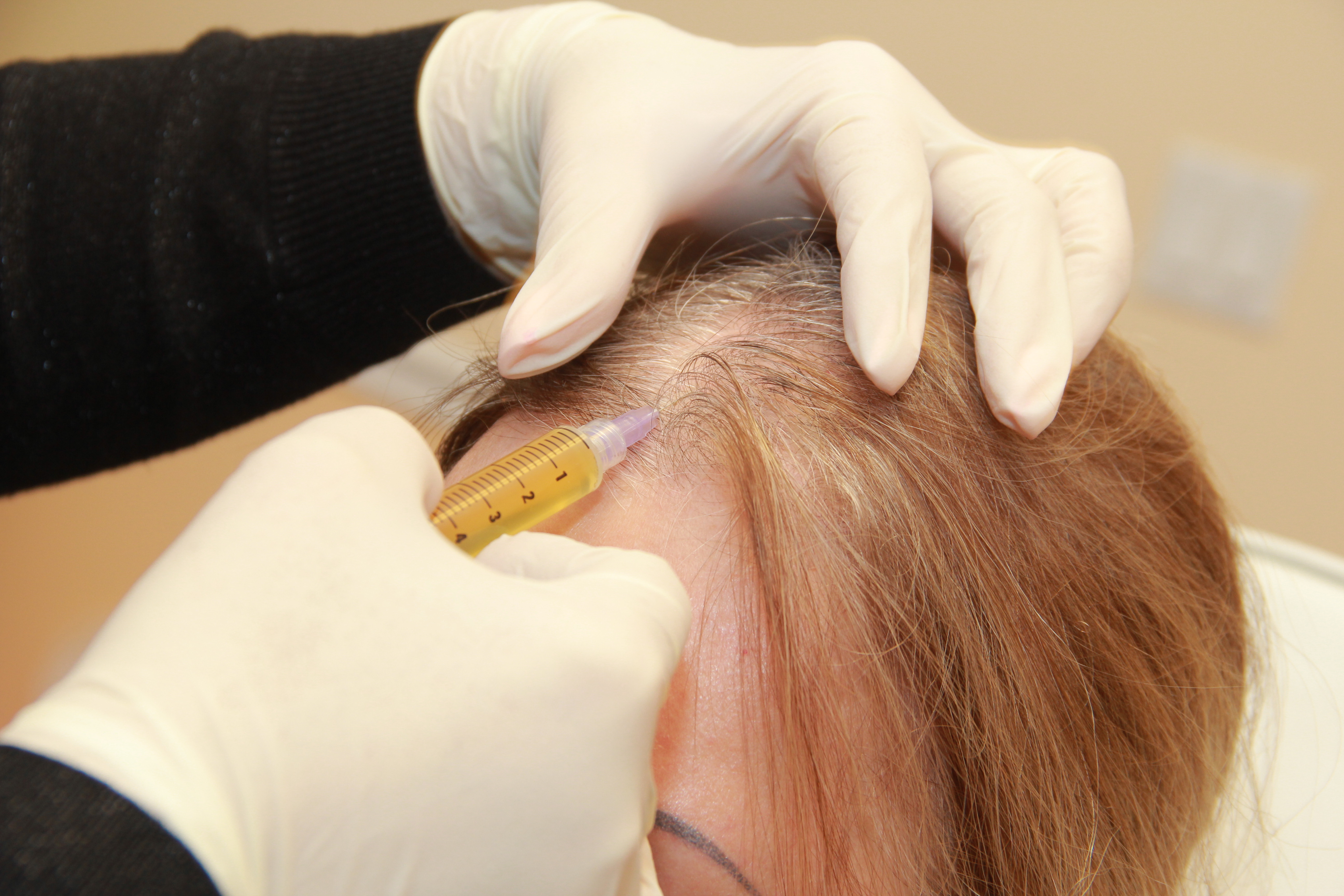 Выпадают волосы процедуры. Плазмотерапия для волос. PRP плазмолифтинг для волос. Плазмотерапия волосистой части головы. PRP-терапия (плазмотерапия) для волос.