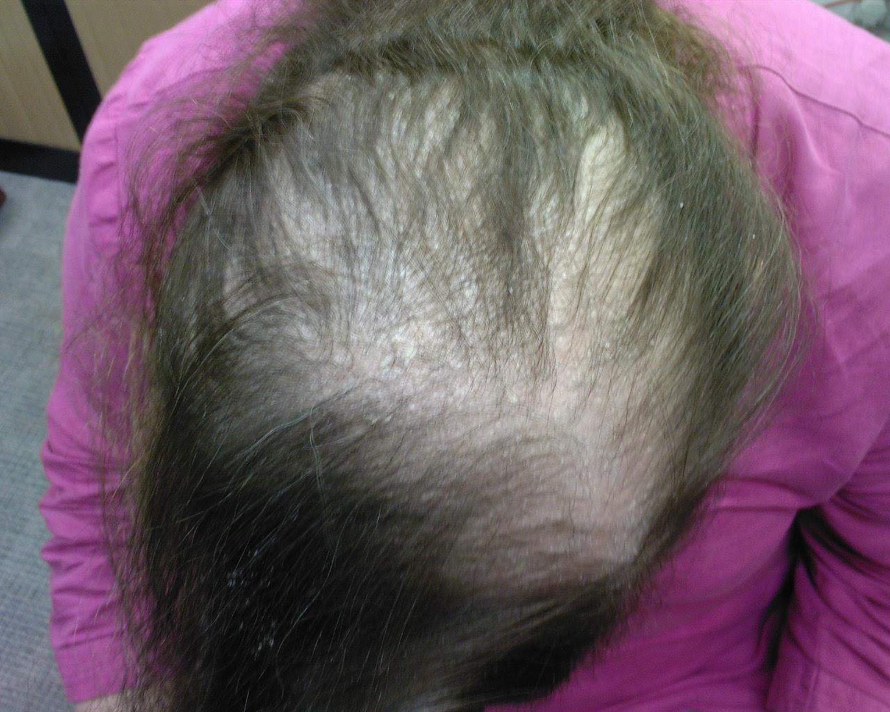 Сильное выпадение волос на голове