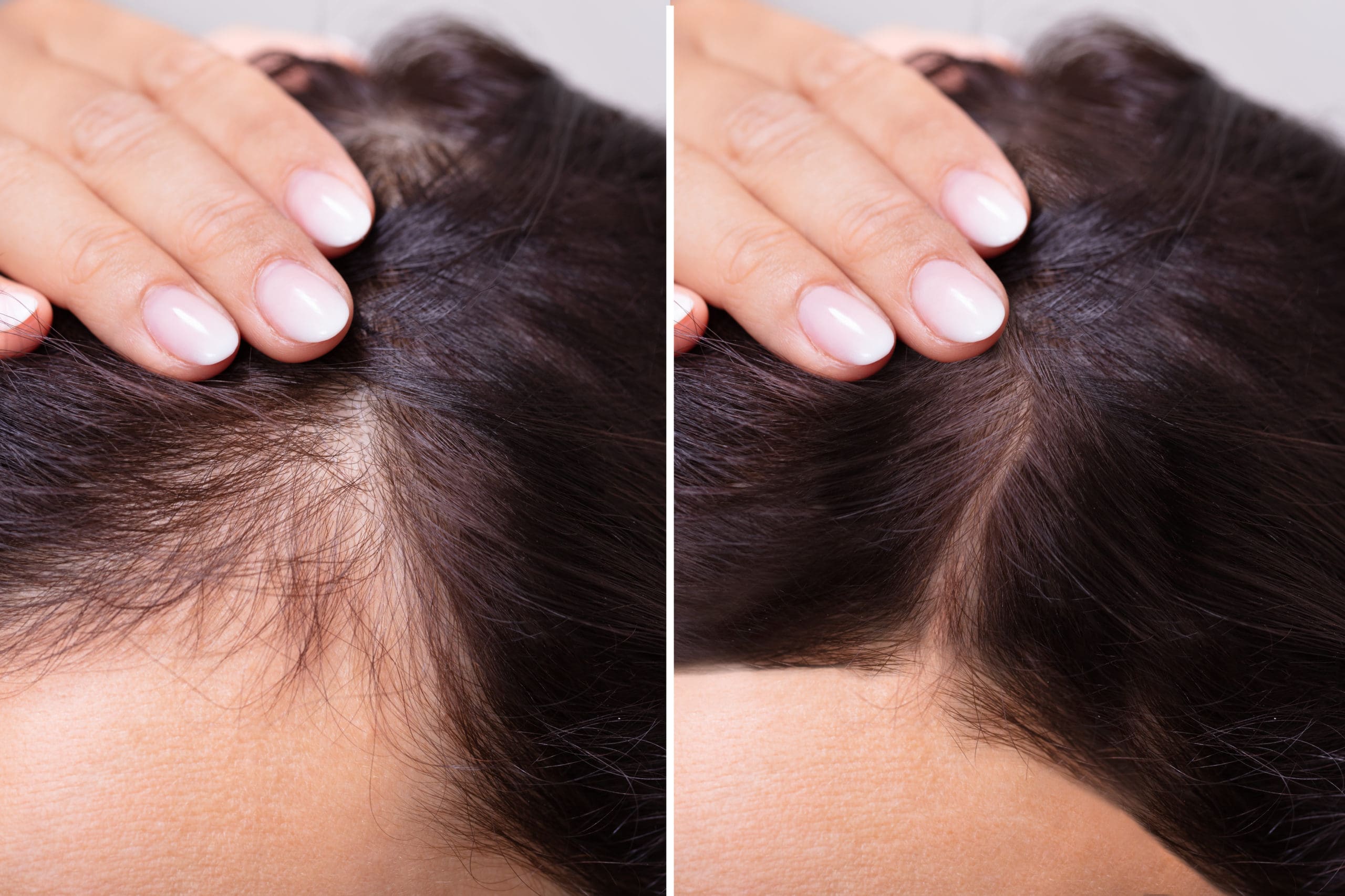 У женщины очень сильно выпадают волосы. Мезотерапия для волос. Выпадение волос до и после. Мезотерапия волос до и после. Мезотерапия волос головы.