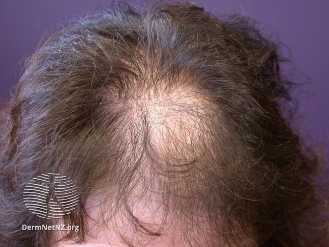 Чем отличается диффузное выпадение волос от андрогенного