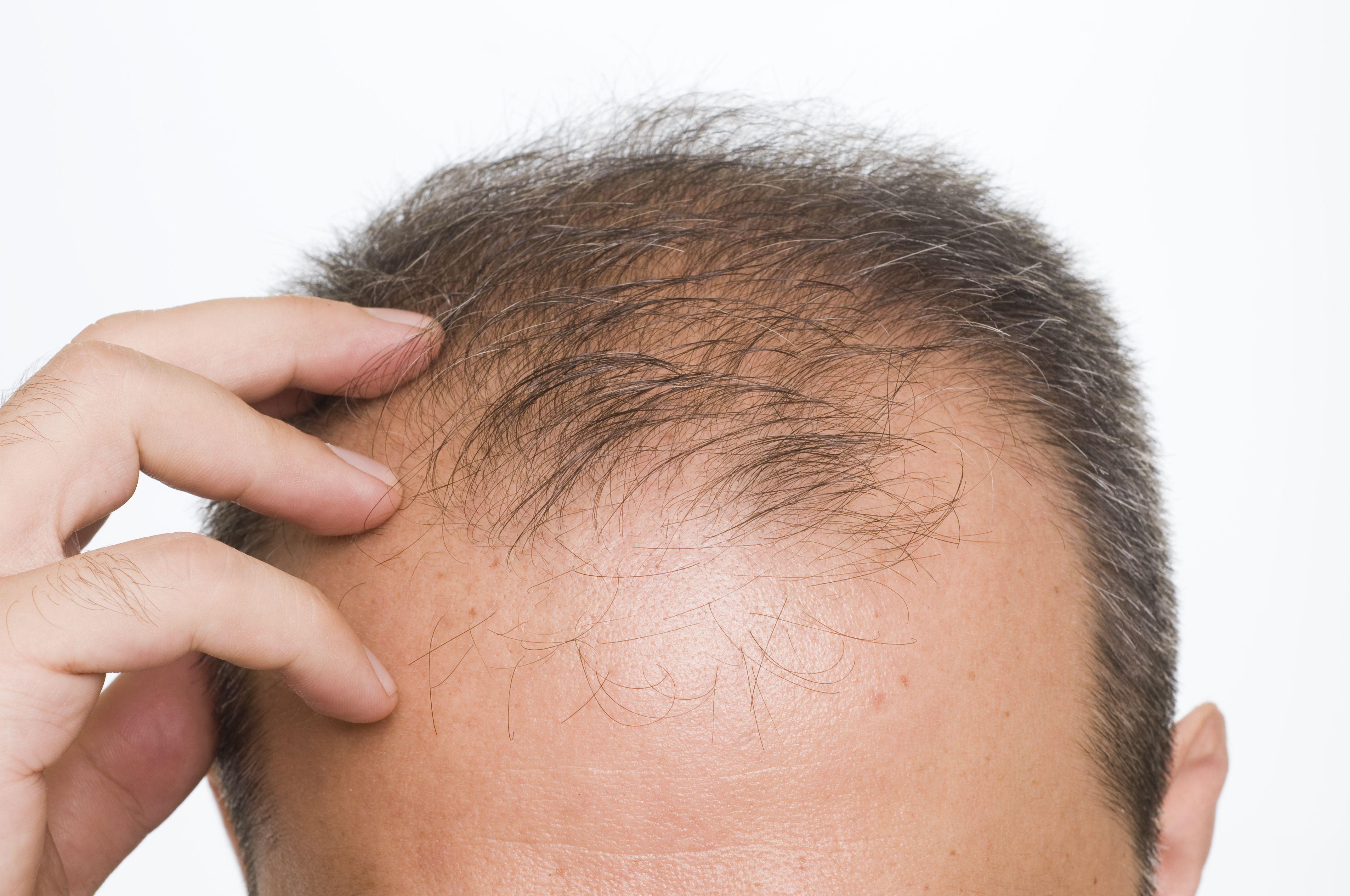 Как остановить выпадение волос при псориазе на голове