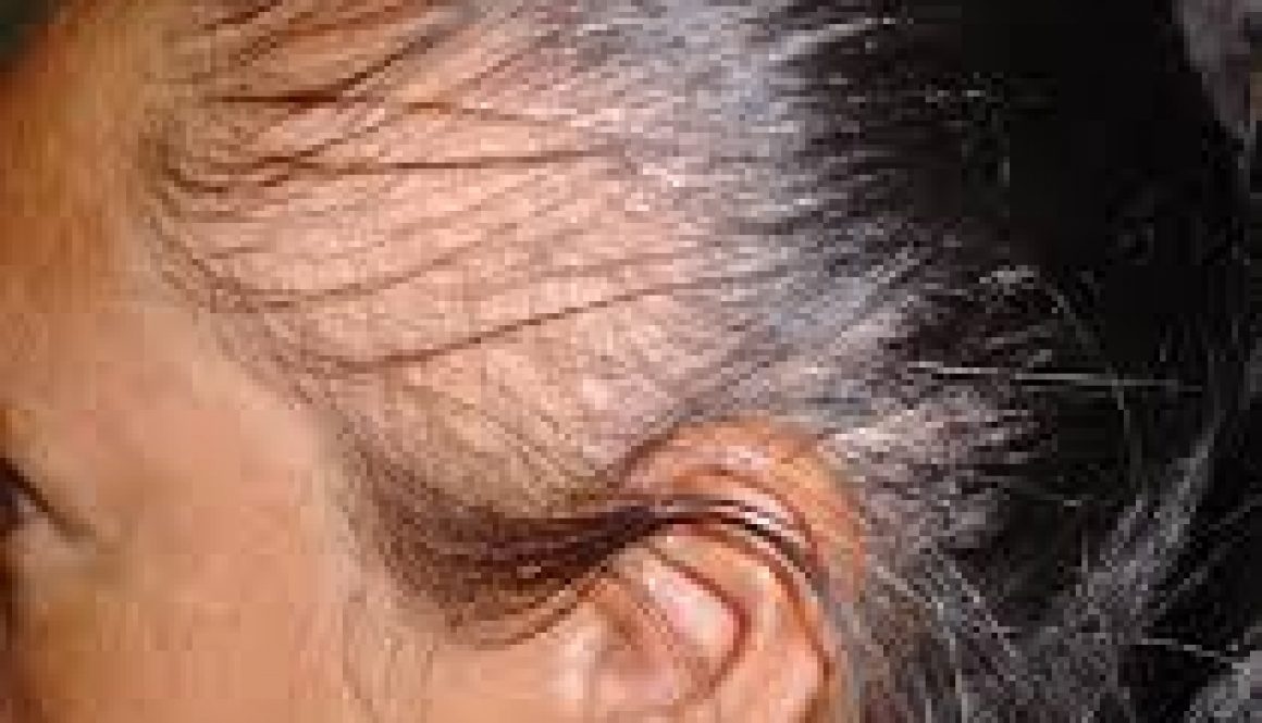 Выпадение волос при заболевании эндокринной системы